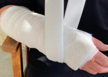 σπασμενο χερι, νοσοκομειο