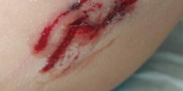 Καστοριά: Αδέσποτο τσομπανόσκυλο επιτέθηκε και δάγκωσε δύο οκτάχρονα παιδιά