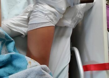 26χρονη τραυματίστηκε από ομπρέλα στην παραλία: «Θύμα» των ισχυρών ανέμων