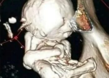 Πόνος στη μέση ήταν «πετρωμένο» μωρό που κυοφορούσε 40 χρόνια – Η εξαιρετικά σπάνια πάθηση της