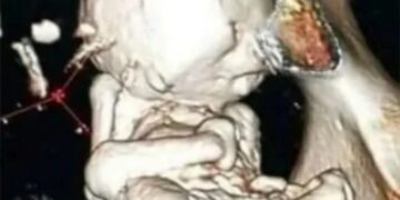 Πόνος στη μέση ήταν «πετρωμένο» μωρό που κυοφορούσε 40 χρόνια – Η εξαιρετικά σπάνια πάθηση της